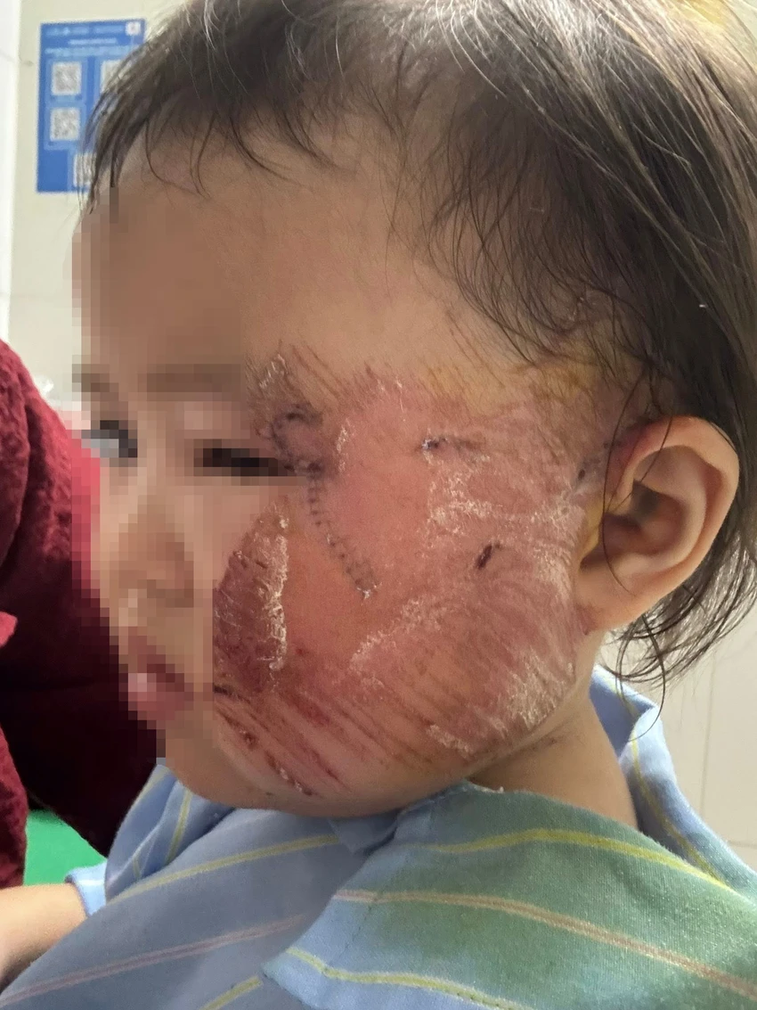 Hình ảnh học sinh bị thương ở vùng mặt do trần thạch cao sập. tran-thach-cao-sap.jpg