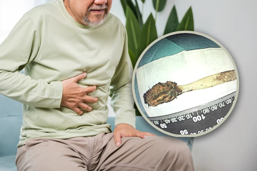 Ông Dương phát hiện bàn chải đánh răng trong ruột sau khi vào viện vì đau ngực.jpg