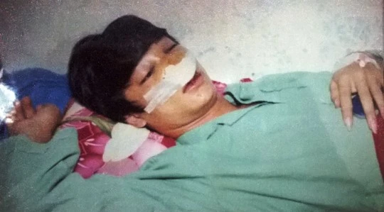Đình khi vừa phẫu thuật mũi tại Bệnh viện Đa Khoa Kon Tum - Ảnh do gia đình cung cấp Đình khi vừa phẫu thuật mũi tại Bệnh viện Đa Khoa Kon Tum - Ảnh do gia đình cung cấp