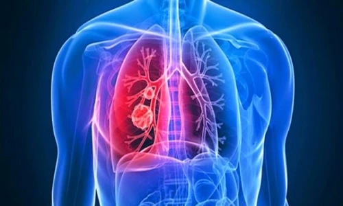 Những dấu hiệu cảnh báo ung thư phổi bạn chớ bỏ qua.
