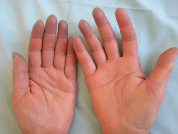 8 nguyên nhân khiến tay chân bạn lúc nào cũng lạnh ảnh 1 8 nguyên nhân khiến tay chân bạn lúc nào cũng lạnh ảnh 1
