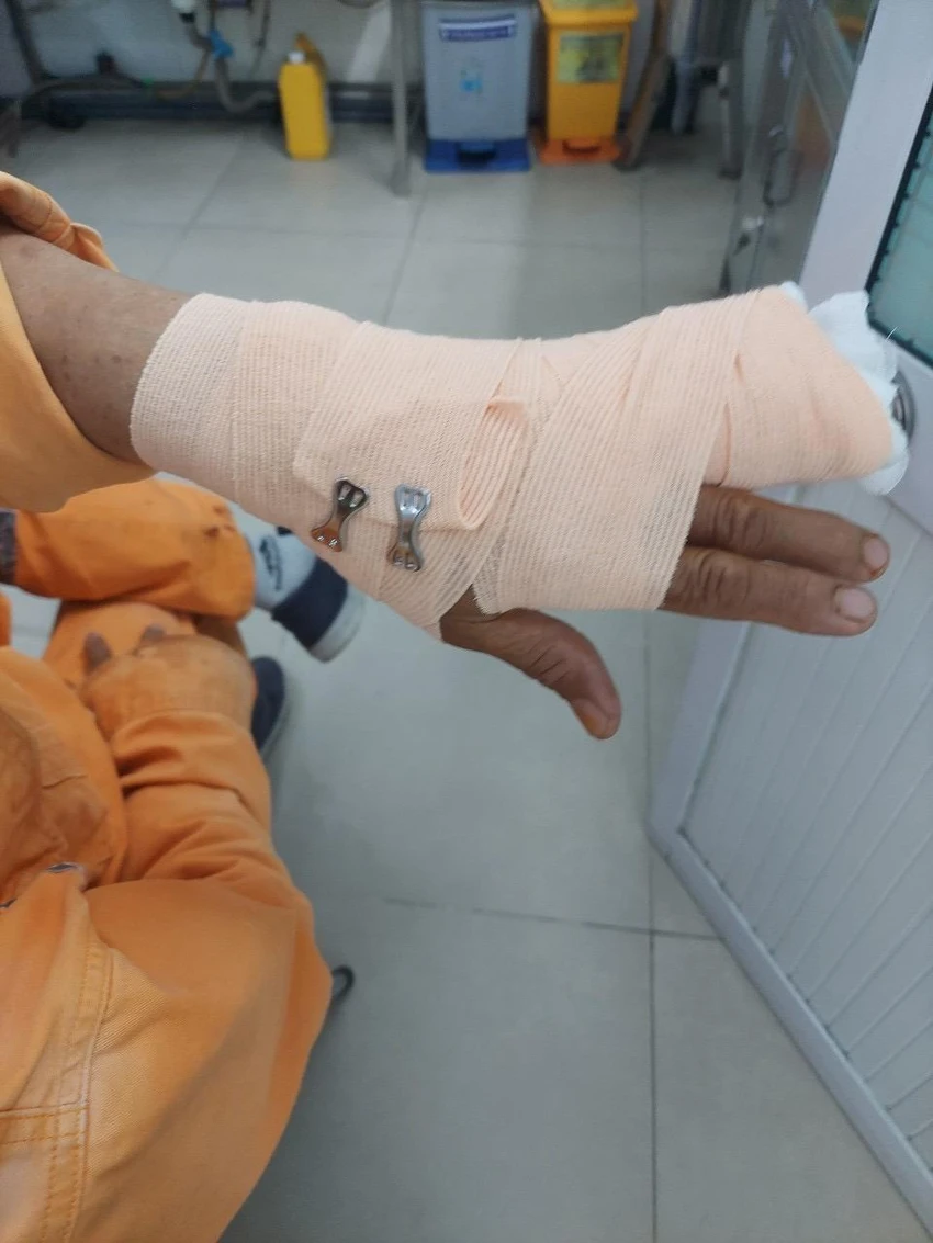 Nhân viên ngành điện bị đánh đứt gân tay. Ảnh: CTV. Nhân viên ngành điện bị đánh đứt gân tay. Ảnh: CTV.