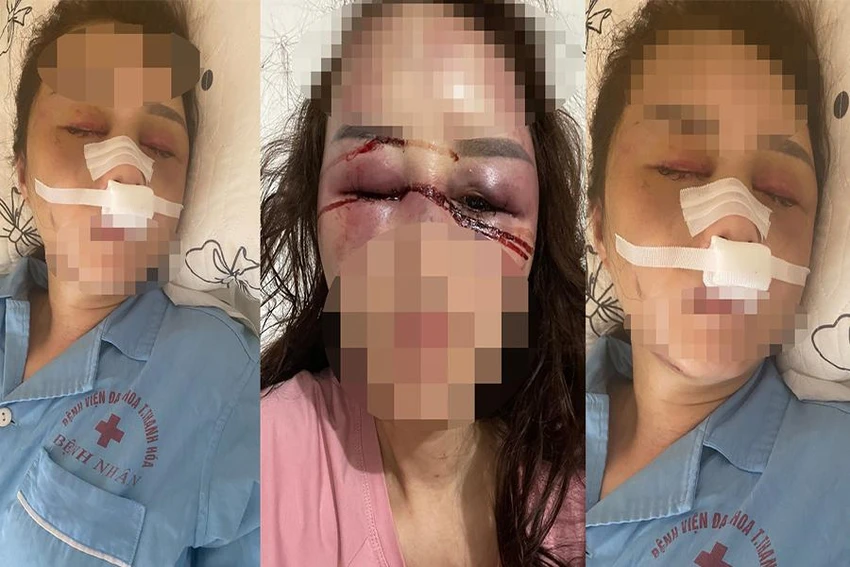 Sức khỏe chị V. bước đầu tạm ổn định sau khi được phẫu thuật nâng phần mũi chính bị dập. Ảnh: ĐẶNG TRUNG Sức khỏe chị V. bước đầu tạm ổn định sau khi được phẫu thuật nâng phần mũi chính bị dập. Ảnh: ĐẶNG TRUNG