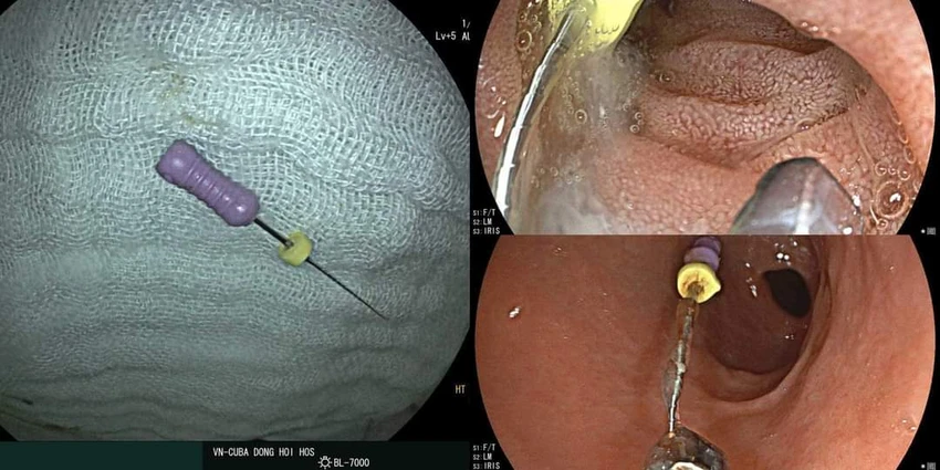 Bé gái 5 tuổi ở Quảng Bình nuốt cây kim dài 2,5cm vào bụng