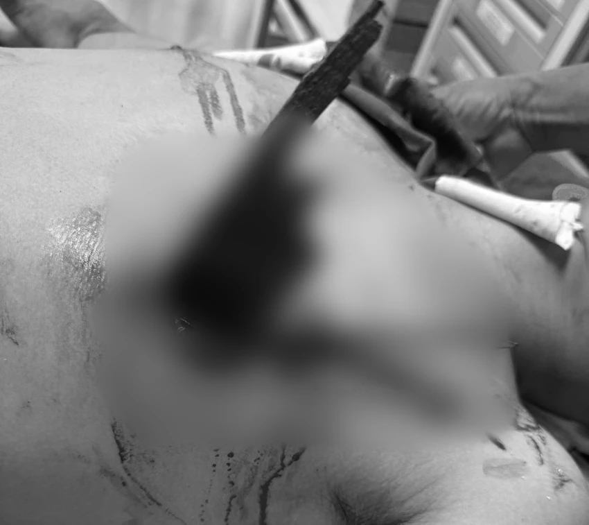 Đi xe máy tông vào hàng rào, nam thanh niên bị thanh gỗ đâm xuyên ngực