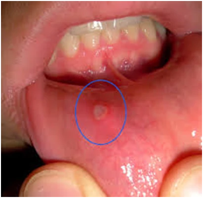 15 dấu hiệu ung thư đàn ông dễ bỏ qua ảnh 8