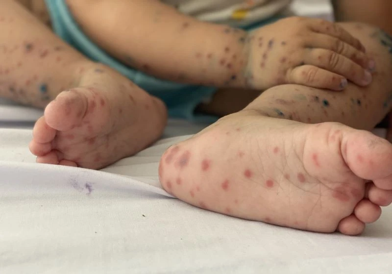Vaccine phòng tay chân miệng đã được nhập khẩu vào Việt Nam. Ảnh minh hoạ Vaccine phòng tay chân miệng đã được nhập khẩu vào Việt Nam. Ảnh minh hoạ
