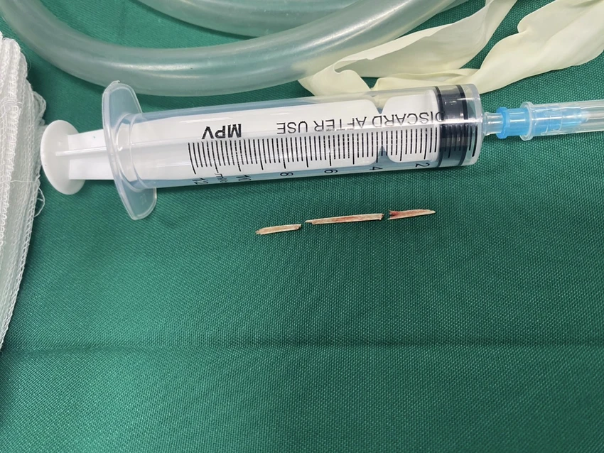 Hình ảnh dị vật đâm thủng dạ dày của nữ bệnh nhân.jpeg