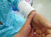 Tái tạo dương vật mới cho khổ chủ