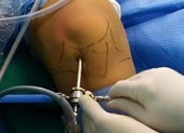 Chơi bóng rổ té, tự uống thuốc giảm đau, phải phẫu thuật