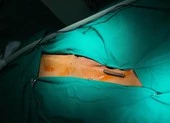 Nhảy từ trên xe xuống đất, bị thanh sắt dài xuyên thấu đùi 