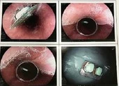 Suýt nguy kịch vì uống thuốc còn nguyên vỏ