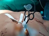 Bất cẩn, người đàn ông bị kéo đâm thủng màng tim