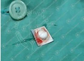 Ho ra máu vì uống nhầm viên thuốc chưa bóc vỏ