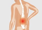 Cảnh báo viêm khớp cột sống gây tàn phế người trẻ