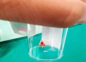Lý do khó tin khiến bé gái đau ngực mỗi khi chạy nhảy 
