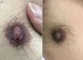 Hy hữu: Nam thanh niên bị giang mai ở đầu vú