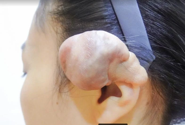 Vành tai trái chị T. nổi khối u to tướng do xỏ 6 khuyên. Ảnh: BVCC