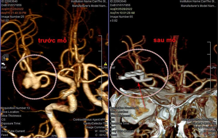 Hình ảnh chụp CT cho thấy bà V. bị vỡ mạch máu não trước và sau điều trị. Ảnh: BVCC Hình ảnh chụp CT cho thấy bà V. bị vỡ mạch máu não trước và sau điều trị. Ảnh: BVCC