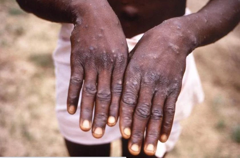 Một bệnh nhân mắc bệnh đậu mùa khỉ ở Nigeria. Ảnh: THE GUARDIAN Một bệnh nhân mắc bệnh đậu mùa khỉ ở Nigeria. Ảnh: THE GUARDIAN