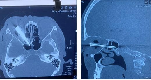 Cây đinh dài 5 cm đâm xuyên mắt phải ông H. Ảnh: BVCC Cây đinh dài 5 cm đâm xuyên mắt phải ông H. Ảnh: BVCC