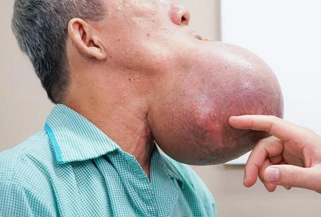 Khối u khổng lồ trên mặt ông K. có dấu hiệu hoại tử. Ảnh: BVCC Khối u khổng lồ trên mặt ông K. có dấu hiệu hoại tử. Ảnh: BVCC