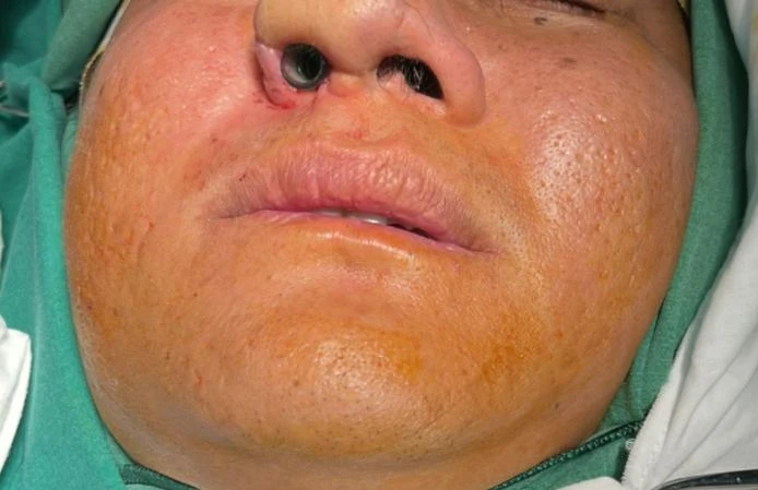 Cánh mũi phải ông V. sau khi phẫu thuật. Ảnh: TRẦN NGỌC Cánh mũi phải ông V. sau khi phẫu thuật. Ảnh: TRẦN NGỌC