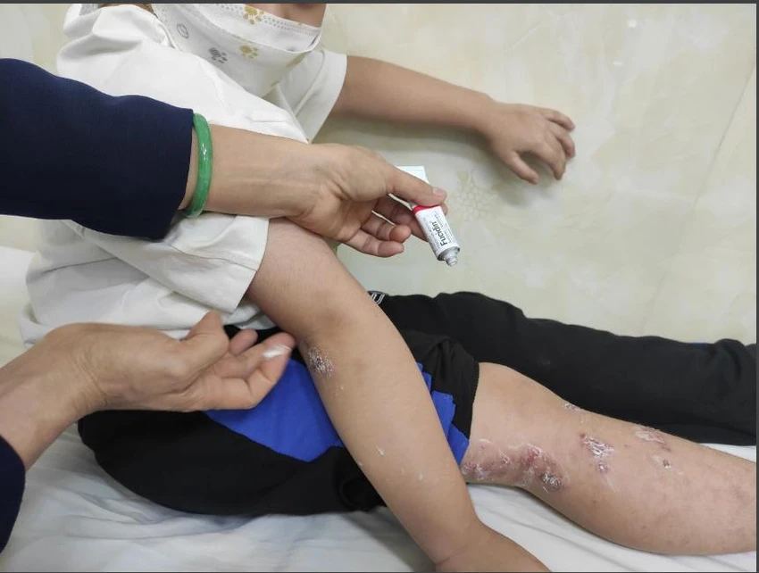 Một trẻ bị chốc đang được bôi thuốc điều trị. Ảnh: BVCC Một trẻ bị chốc đang được bôi thuốc điều trị. Ảnh: BVCC