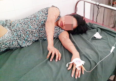 Một phụ nữ bị chủ quán cơm tra tấn dã man ảnh 1 Ngoài những chấn thương trên cơ thể, chị Kết đang bị hoảng loạn tâm lý.