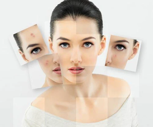 Ngừa mụn cho da dầu trong mùa nóng ảnh 1