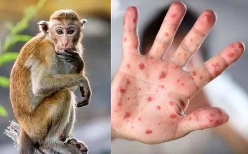 tiền giang phát hiện ca đậu mùa khỉ đầu tiên