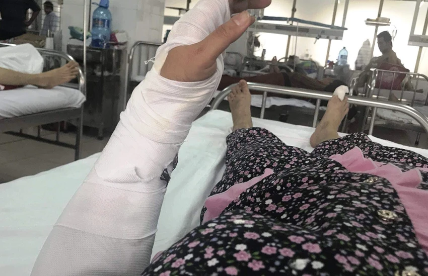 Người vợ bị gãy tay và nhiều vết thương khác. Ảnh: Chị P cung cấp Người vợ bị gãy tay và nhiều vết thương khác. Ảnh: Chị P cung cấp