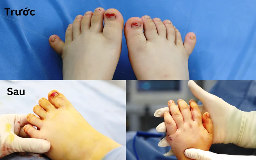 Các chi của bé gái trước và sau phẫu thuật. Ảnh: BVCC Các chi của bé gái trước và sau phẫu thuật. Ảnh: BVCC