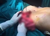 Cứu sống bệnh nhân bị máy cưa gỗ chém thủng bụng