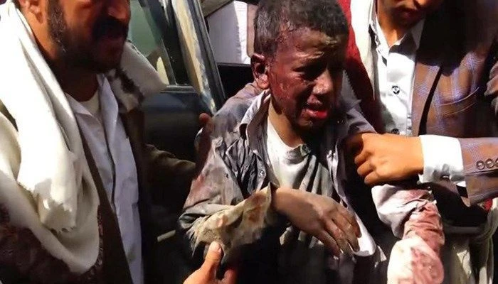 Nạn nhân trẻ em trong trận không kích sáng 9-8 ở Yemen đau đớn tại bệnh viện. Ảnh: AFP