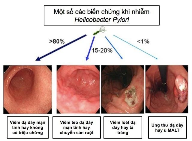 Các biến chứng khi nhiễm HP