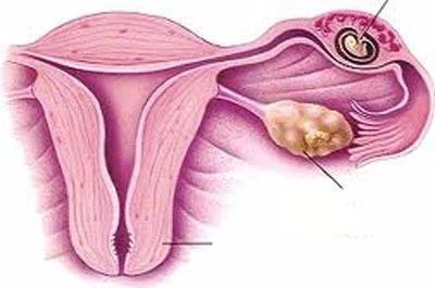 Thai ngoài tử cung rất khó nhận biết nếu không để ý. 