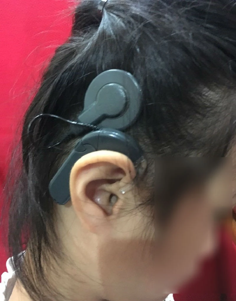 Nhiều cơ hội cấy ốc tai chữa điếc bẩm sinh cho trẻ em ảnh 1 Nhiều cơ hội cấy ốc tai chữa điếc bẩm sinh cho trẻ em ảnh 1