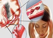 Tại sao trời lạnh dễ bị đột quỵ?
