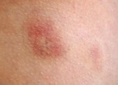 10 biểu hiện lạ trên da có thể là dấu hiệu bệnh nghiêm trọng
