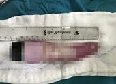 Cứu thanh niên bị mắc kẹt 'của quý' giả