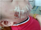 Bé 2 tuổi bị chó nhà nuôi cắn rách mặt