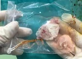 Mổ lấy ổ sán khổng lồ trong não người thích ăn tiết canh 