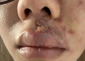 Mặt sưng phù, mưng mủ sau tiêm filler làm đầy rãnh má