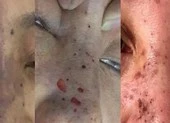 Bắt quả tang ‘bác sĩ' Hàn Quốc làm đẹp chui ở khách sạn
