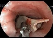 Bé gái 13 tuổi mắc xương đùi gà bự chảng trong cổ họng 