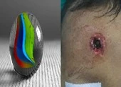 Bé trai bị đạn bị găm vào trán vì súng bắn chim cướp cò