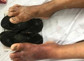 Phát hiện bị đái tháo đường nhờ… dép kẹp