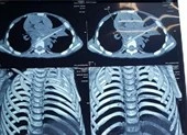 Bị que xiên thịt nướng đâm xuyên phổi, vỡ đốt sống
