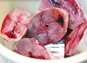Cô gái tổn thương phổi nặng, suýt chết sau khi ăn cá ngừ